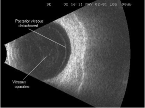 B-Scan Ultrasound