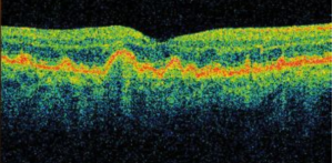 Optical Coherence Tomography 2